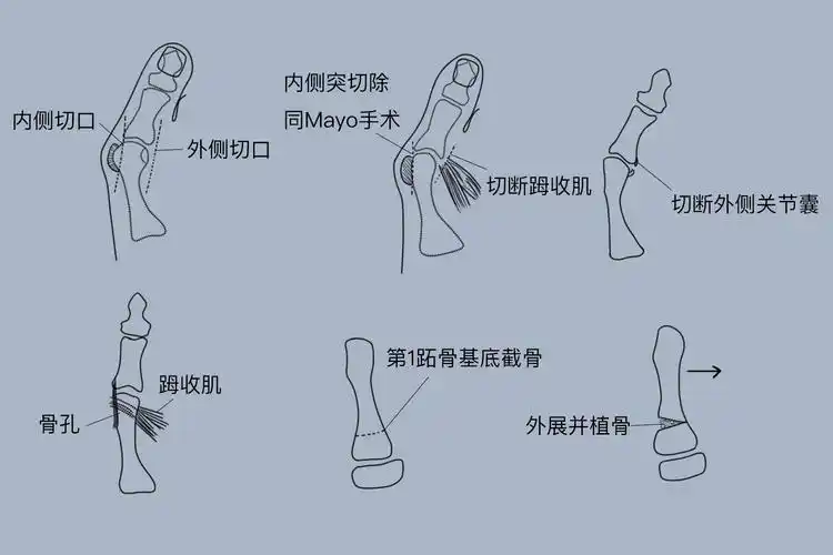 拇外翻角20°-35°,第一跖骨间角 15°,无跖趾关节退变性改变及非手术