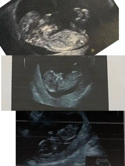 [试管婴儿]nt和13周拍的b超.大家帮忙看看nub点是男是女?