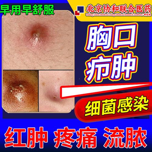 胸口长疖肿皮脂腺囊肿火疖子拔毒拔脓膏吸脓包硬块可搭配膏药贴pg