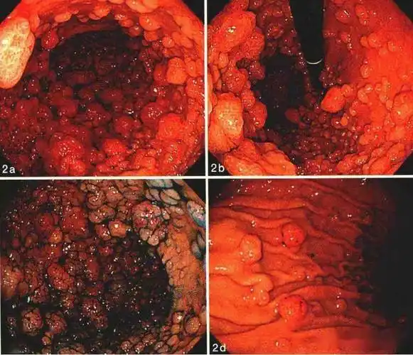 收藏——消化内镜40种常见病图谱_食管_综合征_十二指肠