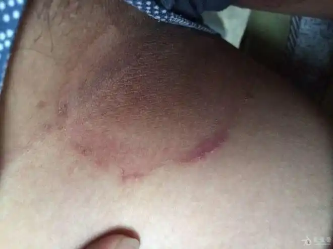 大腿根长红斑和丘疹瘙痒难耐是湿疹还是股癣