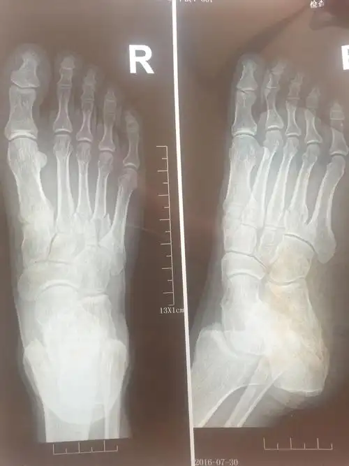 全脚掌走路哪几根跖骨负重?