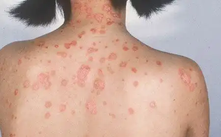 皮肤褐色癣图片