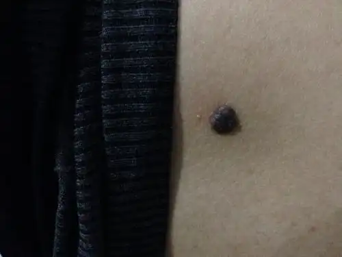 大黑痣,这个痣我小时候就有了,听妈妈说小时候很小的一粒,现在23岁,痣