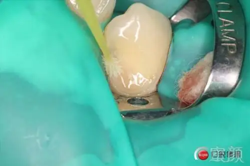 分享一组双尖牙根面龋补牙案例