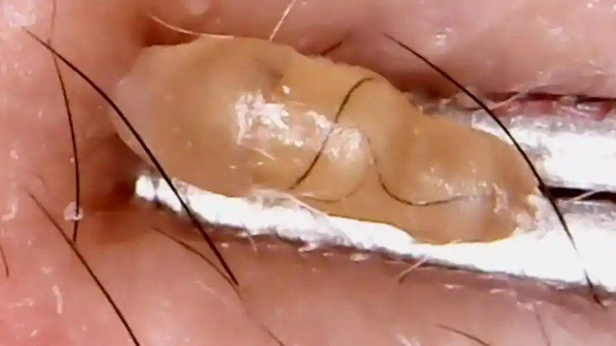 超大只黑头 非常艰难才挤出来