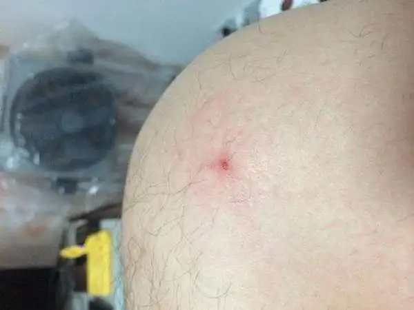 硬下疳是什么样子硬下疳长在哪里一期梅毒又称硬下疳一期梅毒硬下疳