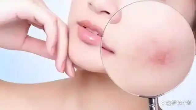 皮肤敏感修复需要多久才能好?关于敏感肌修护,4大疑问解答内容