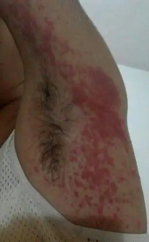 腋下长了一片红疙瘩,白天没事,一到晚上就痒,开始没这么严重后来就成