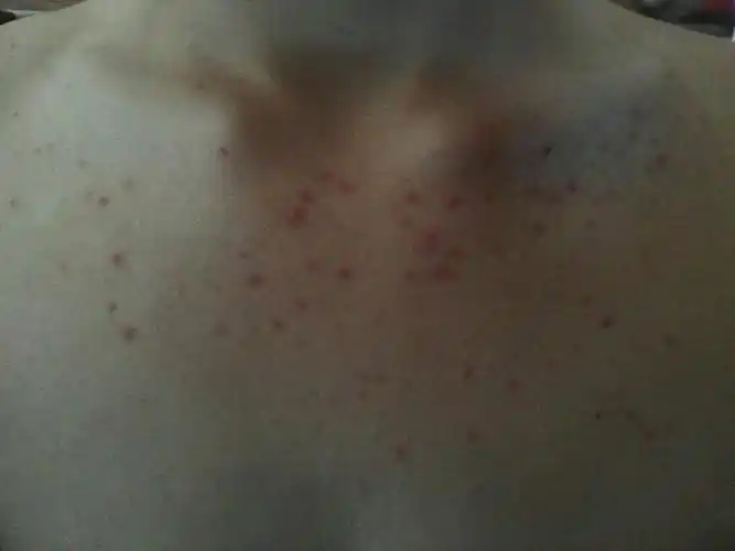 去医院化验了一下没有真菌感染,抹了治毛囊炎的药也没有效果