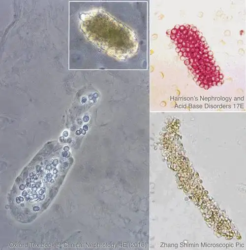horsfall 糖蛋白的纤维状结构有关;(右)光镜下的透明管型图 4 白细胞