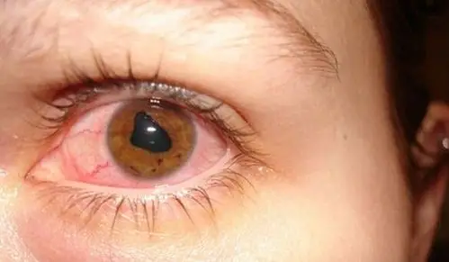 boy   我曾两次患虹膜炎,第一次患虹膜炎的时候我的眼睛看起来如下图