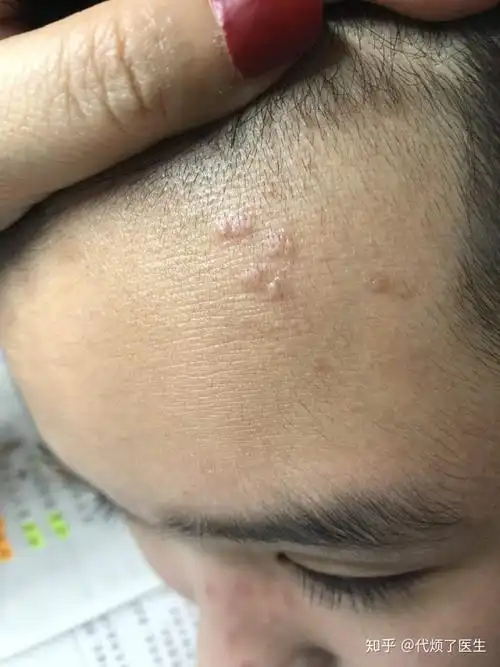 扁平疣寻常疣的清除方法