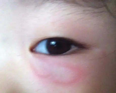 宝宝眼睛下面起个大包,确定不是蚊虫叮咬,早上起几个
