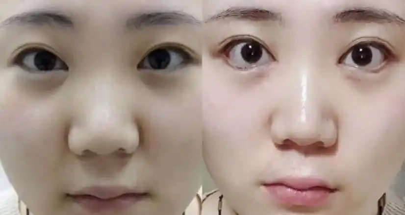 张冰洁下睑下至手术案例