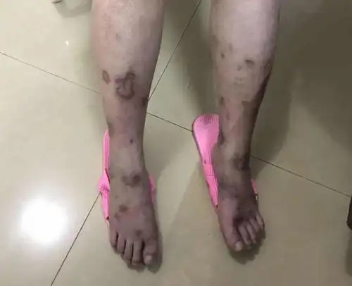 吸带毒的物质的人皮肤症状图片:皮肤黑色素瘤