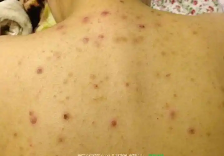 最快2周后背痘消失!还有人不知道吗?_痘痘_皮肤_身体
