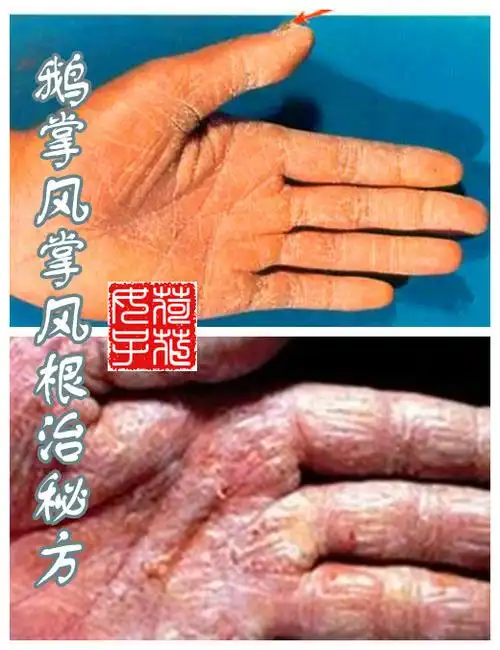 鹅掌风根治秘方