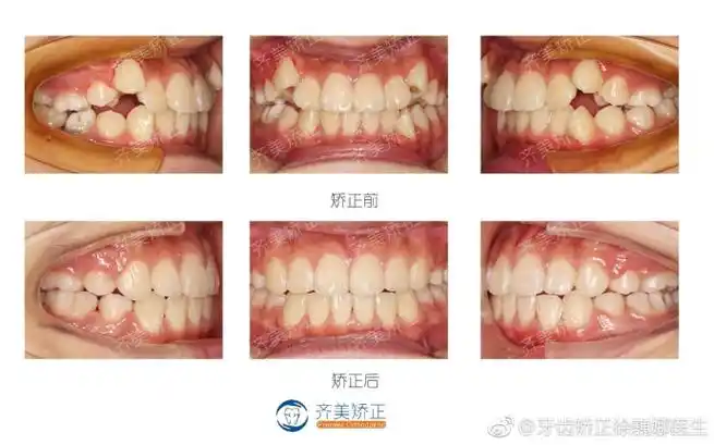二,虎牙与双尖牙错位这位客人,三号牙和四号牙错位,前段牙弓间隙,后段