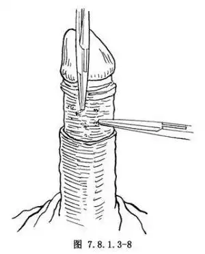 【包皮环切术】包皮环切术手术详细步骤,包皮环切术手术过程_百姓健康