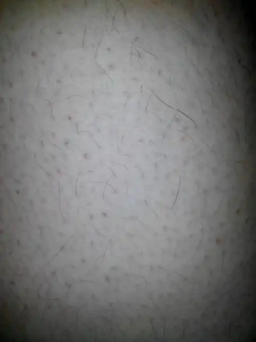 皮肤的毛孔都堵啦,好像是因为衣服不透气的缘故,毛孔的毛不长长使皮肤