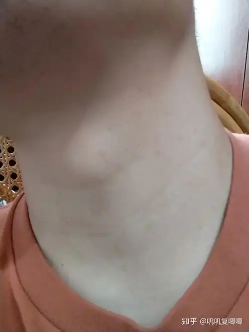 丝状疣脖子上女性医生说要激光扫有别的办法吗