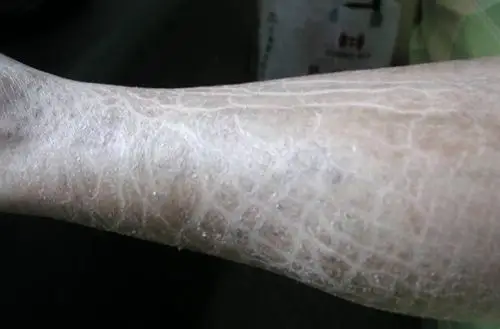 鱼鳞皮肤病 (21)