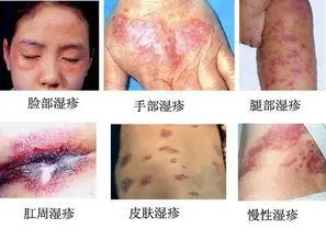 湿疹症状什么样?有图片吗?会加重吗