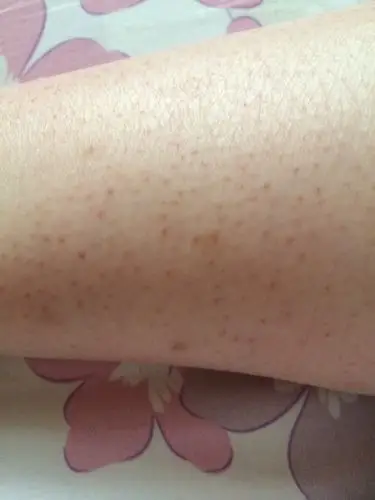 的小疙瘩【也有的是小黑点】,去医院看医生说是毛囊角质化过盛很正常