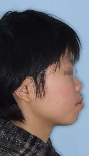 拔牙正畸那点事,看完你就都明白了