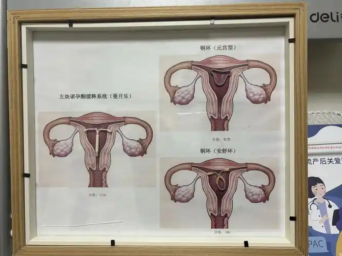 54岁的妈妈,"28岁"的节育环_腾讯新闻