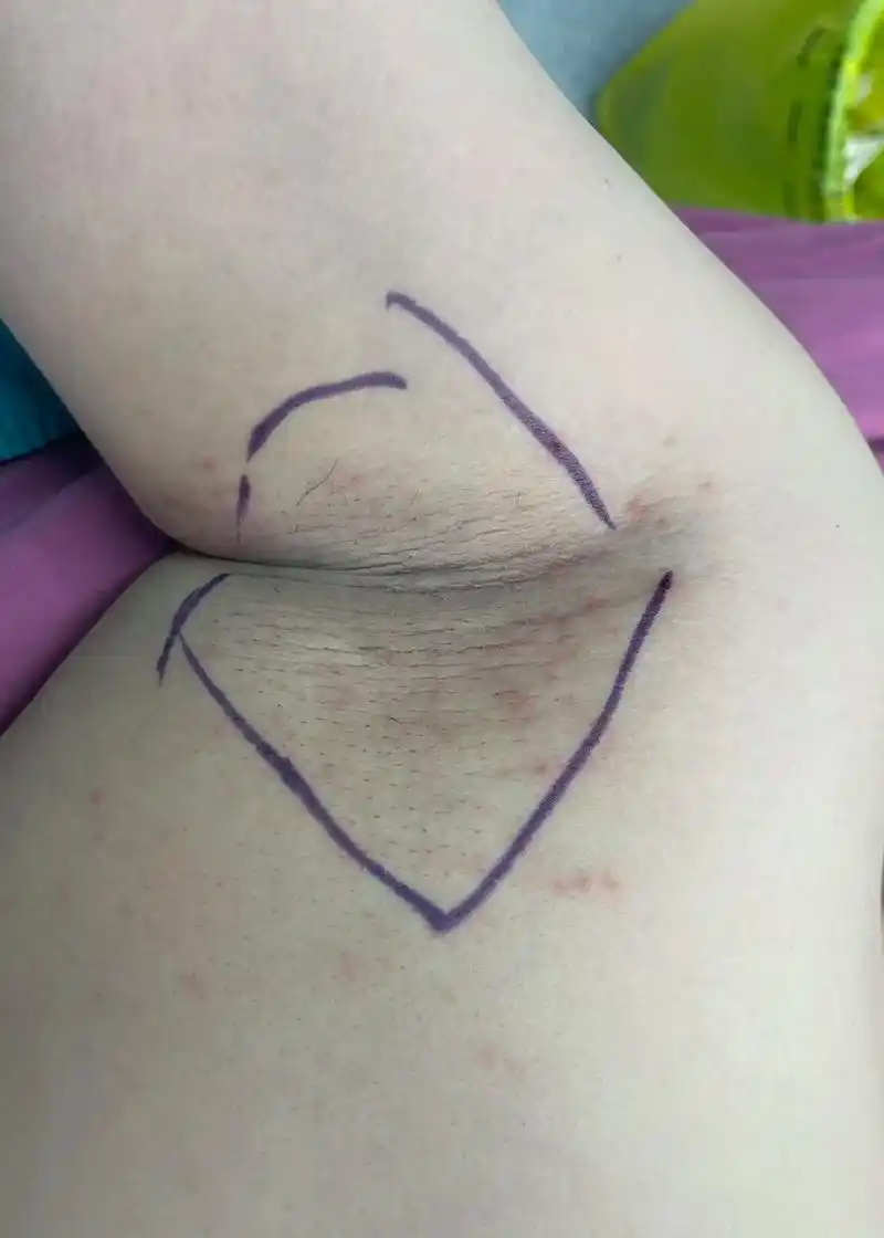 小切口微创腋臭根治术,夏天告别尴尬 #腋臭 #腋臭手术 #八 - 抖音