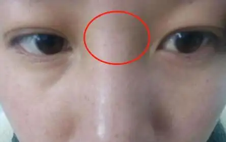 运势难以平顺,且中年婚姻易出现问题,山根有横纹的女性要注意了