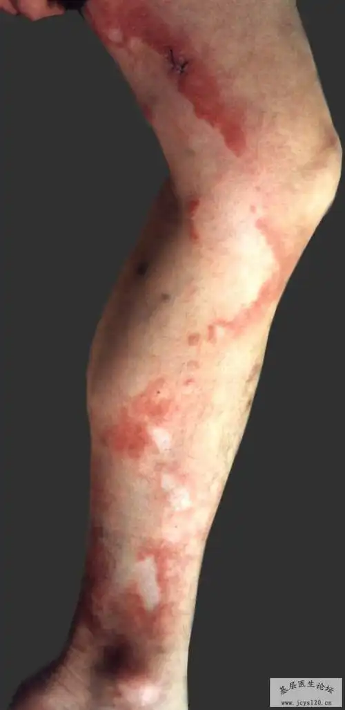 皮肤病图各种皮肤病的图片难得啊
