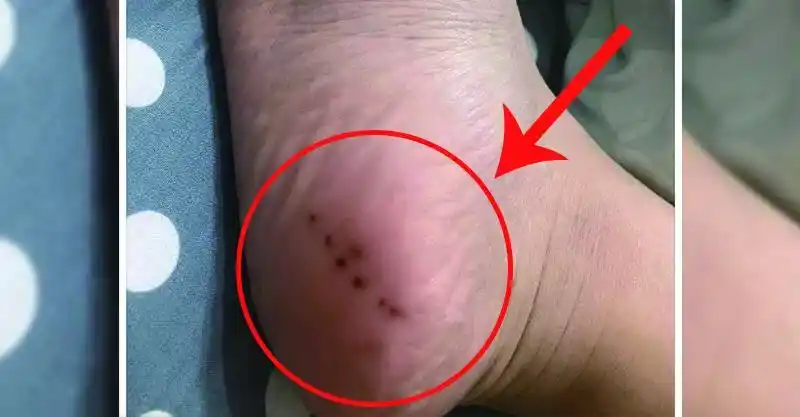 她脚底突然长出「7颗黑痣」!po网搞笑询问.