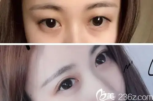 呼市王成毅全切双眼皮前后效果对比图