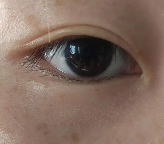 眼睛下面长了一堆密密麻麻的小白点,是什么啊?有没有办法消除啊?