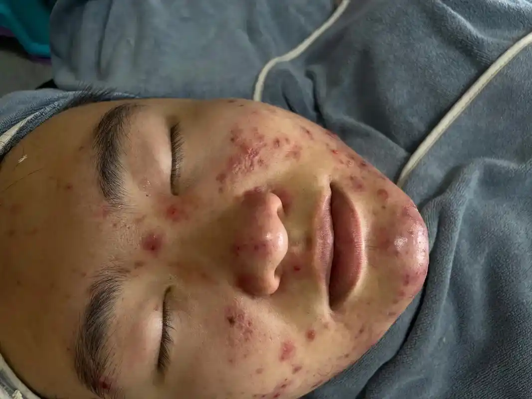 抖音小助手 #痘痘黑头粉刺拜拜 10天的图片.# - 抖音