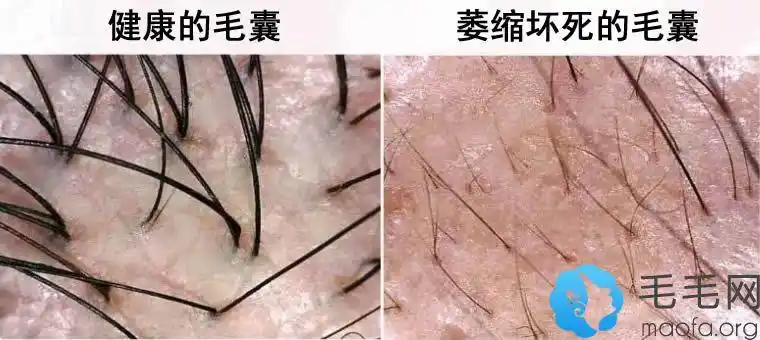 北京瑞丽诗的植发医生指出,毛囊就例如树木的根部,是头发生长的根基