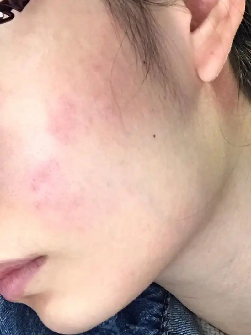 混油皮,印象中脸部从来没有对什么产品过敏过.