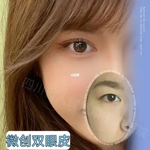 徐墩——微创双眼皮术后_双眼皮_单眼皮_成都双眼皮_美妆_医美整形
