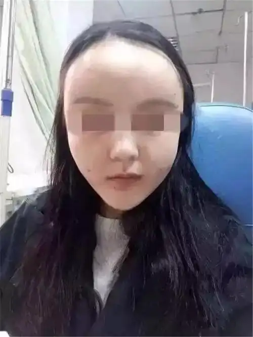 脂肪填充多长时间可以消肿?