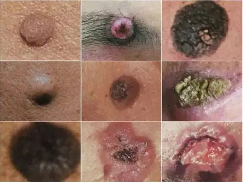 恶性皮肤肿瘤!当心!你的皮肤出现这种表现