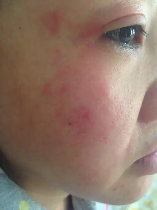 脸部过敏_百度知道