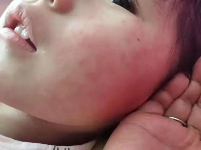 问:麻烦问一下孩子这是不是过敏了?