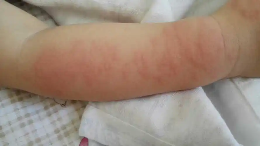 宝宝这两天有点过敏,去张家界那个医院看好啊?