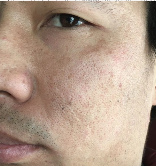 我这脸部皮肤毛孔粗大 怎么治? 30了