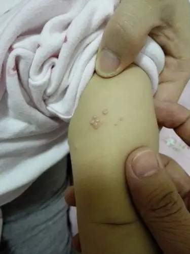 小孩子1岁半,手臂上长了小肉粒,查了下,有点像脂肪粒,也有点像传染性