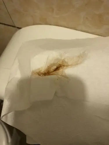 无排卵性dub出血的原因是围绝经期妇女卵巢衰退,卵巢卵泡发育不足到