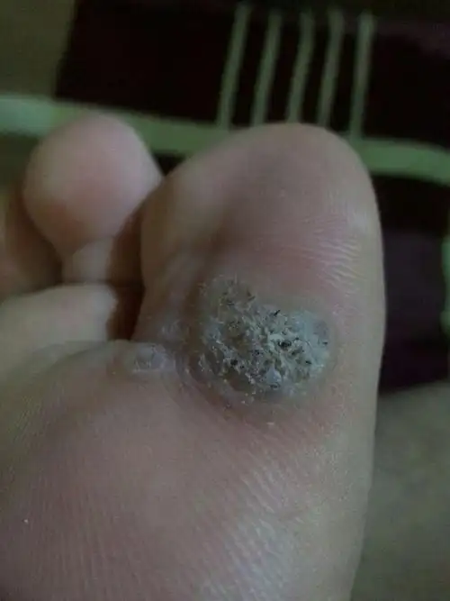 附加图片.请帮我看下是不是鸡眼,该怎么处理